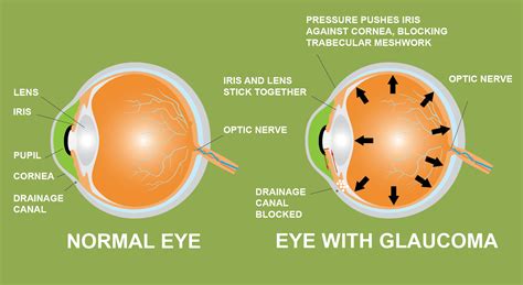 Is Marijuana a Viable Treatment Option for Glaucoma?